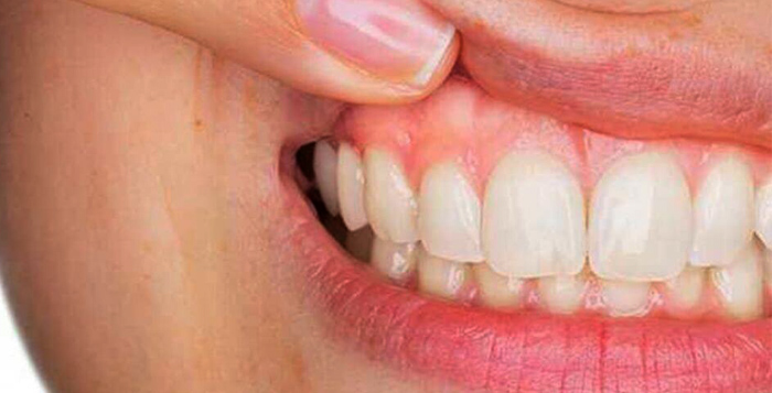 home remedies for gingivitis பல் ஈறு பிரச்சனைகளுக்கு பற்பொடி